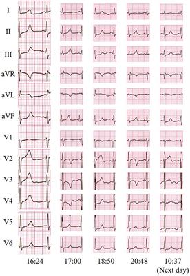 Case Report: Abnormal ECG and Pantalgia in a Patient With Guillain–Barré Syndrome